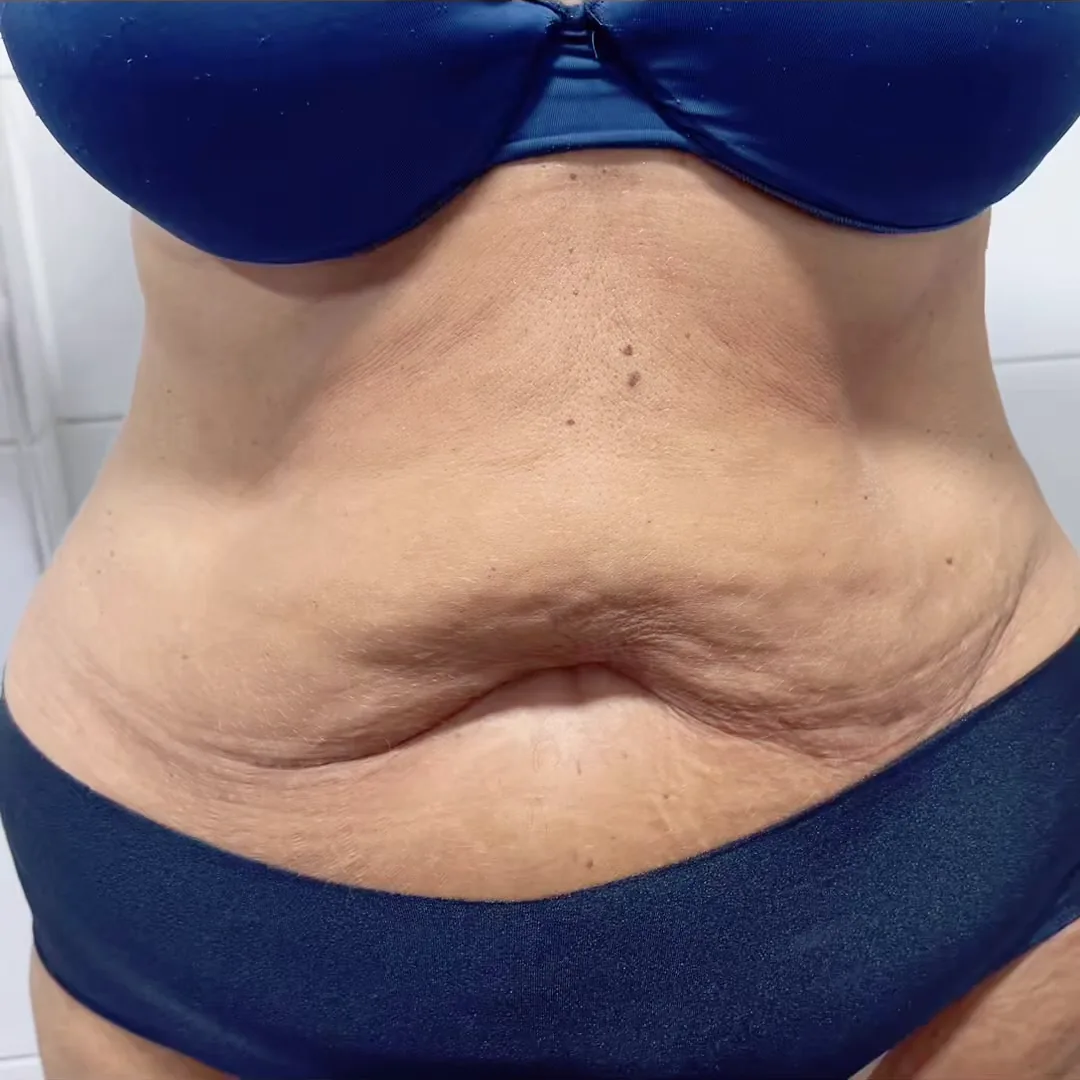 Antes do tratamento: abdómen de uma cliente